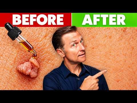 How to Get Rid of Skin Tags (& Stop Them For Good)